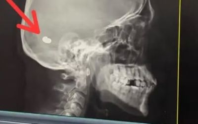 Raio-x mostra objeto semelhante a projétil alojado no crânio de paciente que relatou dor de cabeça em SC